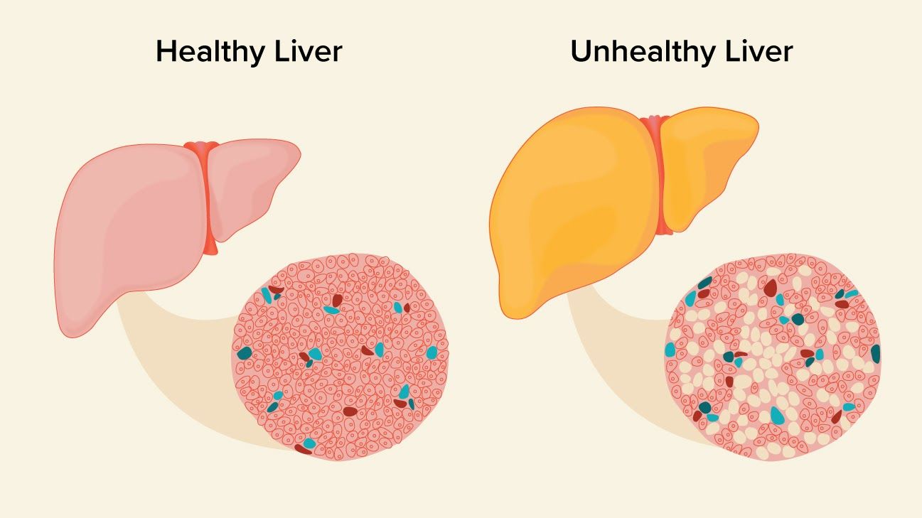 treat fatty liver