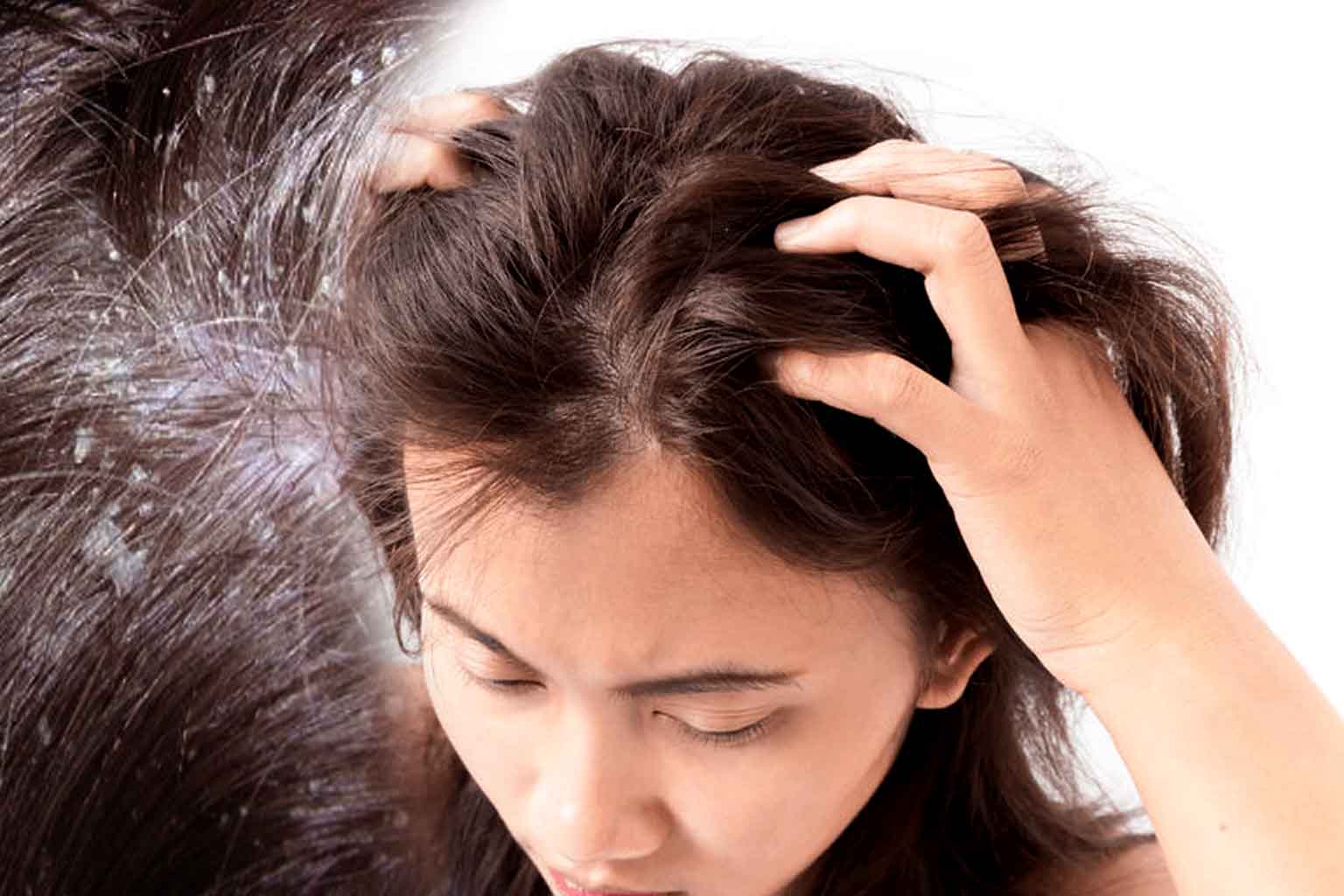 secret hacks for dry scalp
