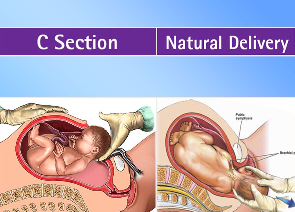 C-section and vaginal delivery