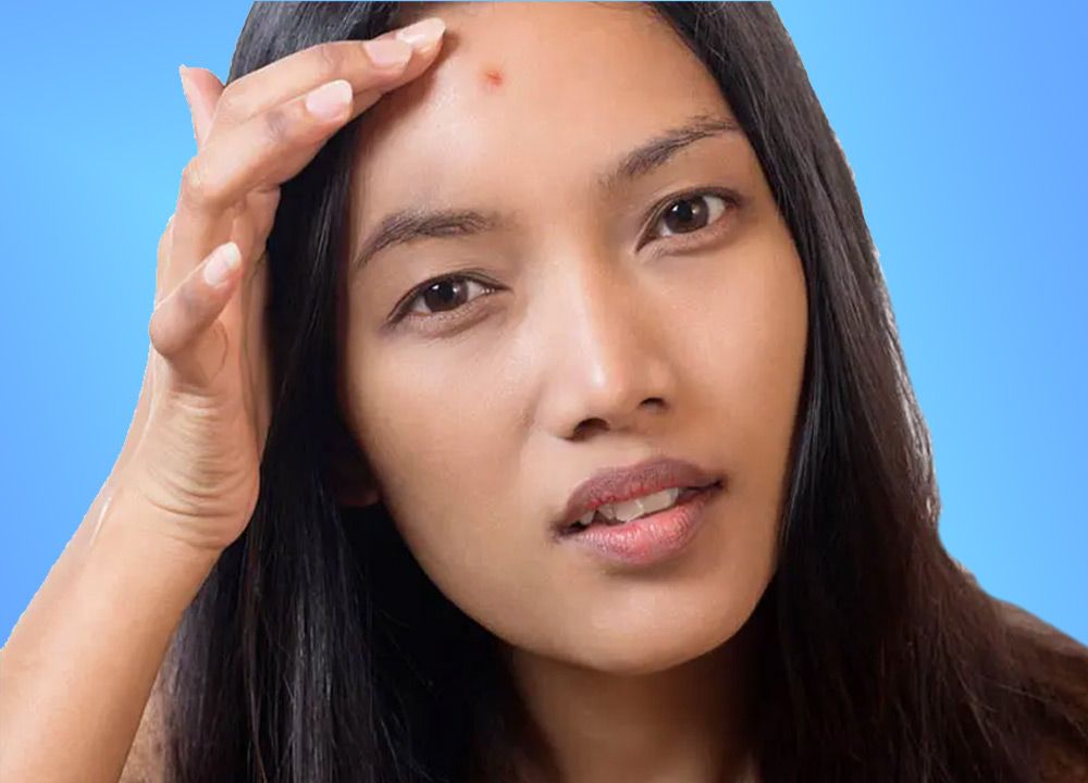 Forehead Acne Causes and Treatments