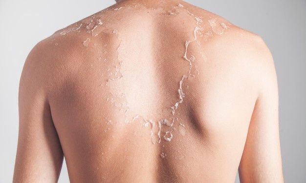 Tips to Soothe Sunburn