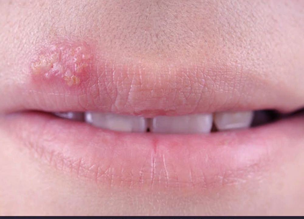 How To Detect Herpes
