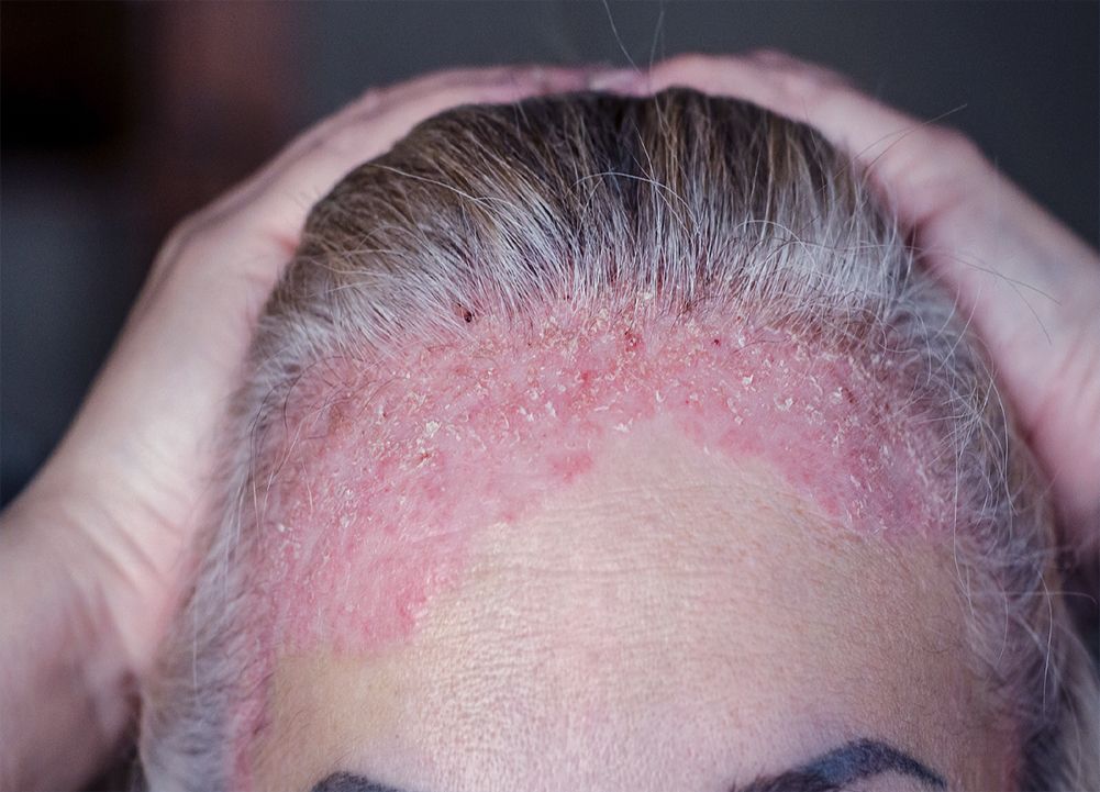 Know Why You Have Scalp Psoriasis | Treatments for You