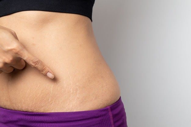 stretch marks home remedies