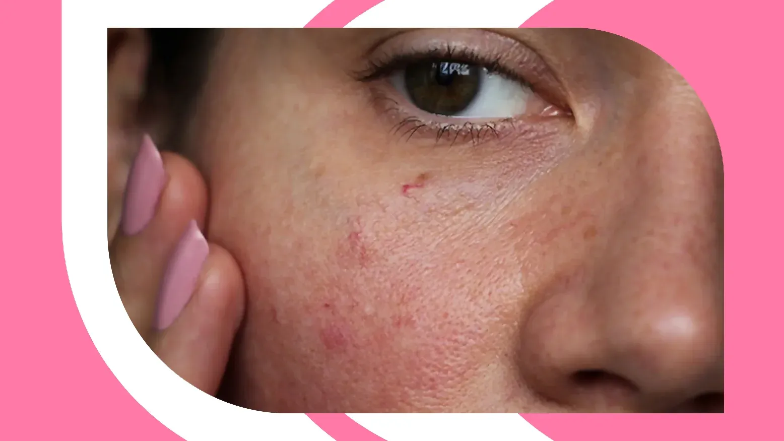 Signs Of Over Exfoliated Skin