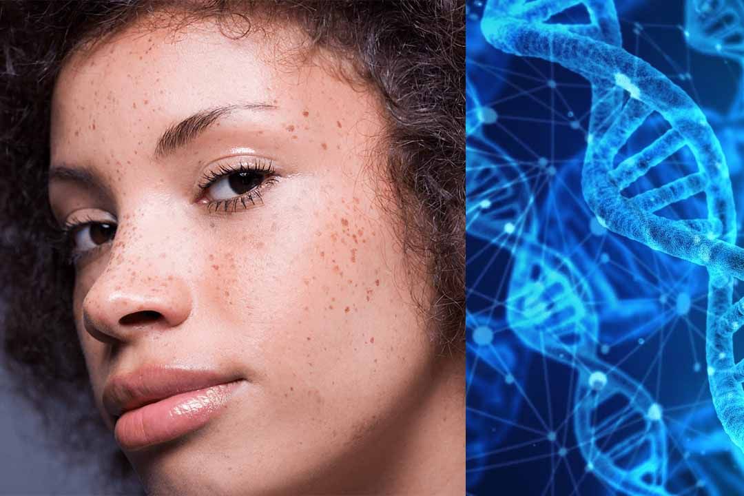 Can Genetics Cause Skin Cancer