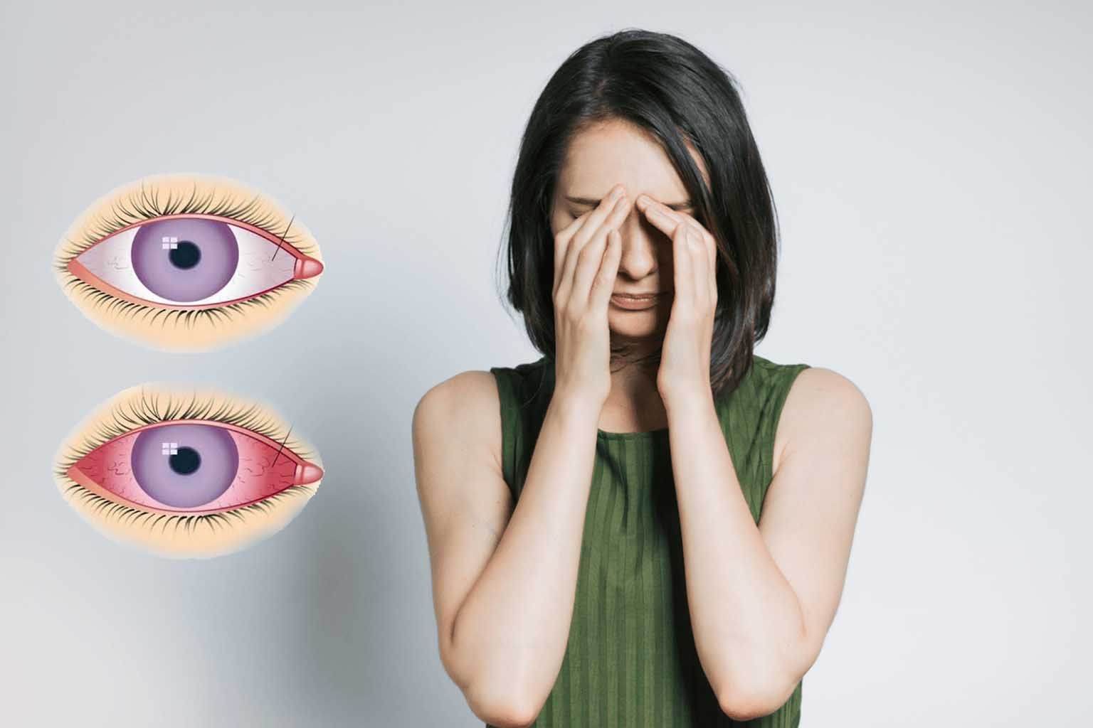 Remedies for Conjunctivitis