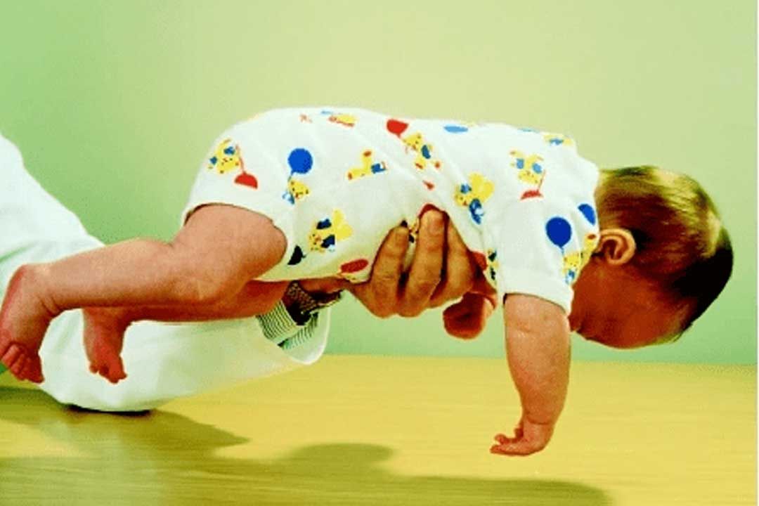 Guide to Floppy Baby Syndrome and Treatments