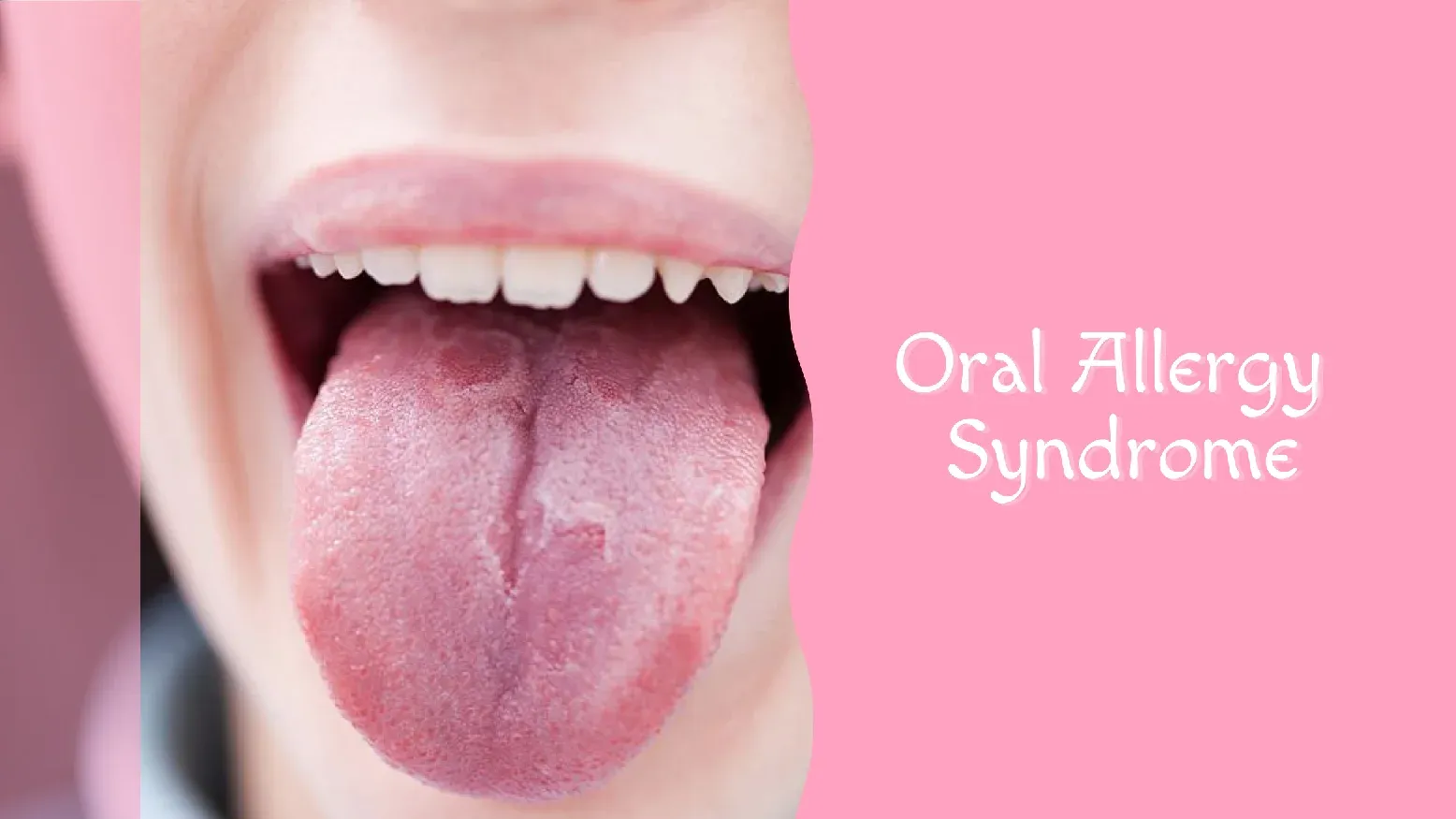 Oral Allergy Syndrome