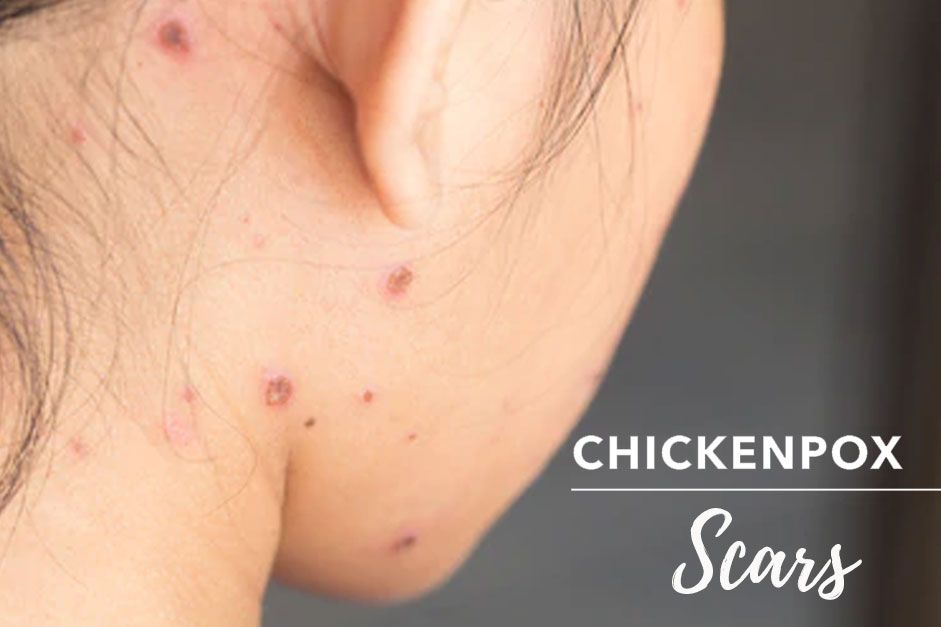 Chicken pox scars