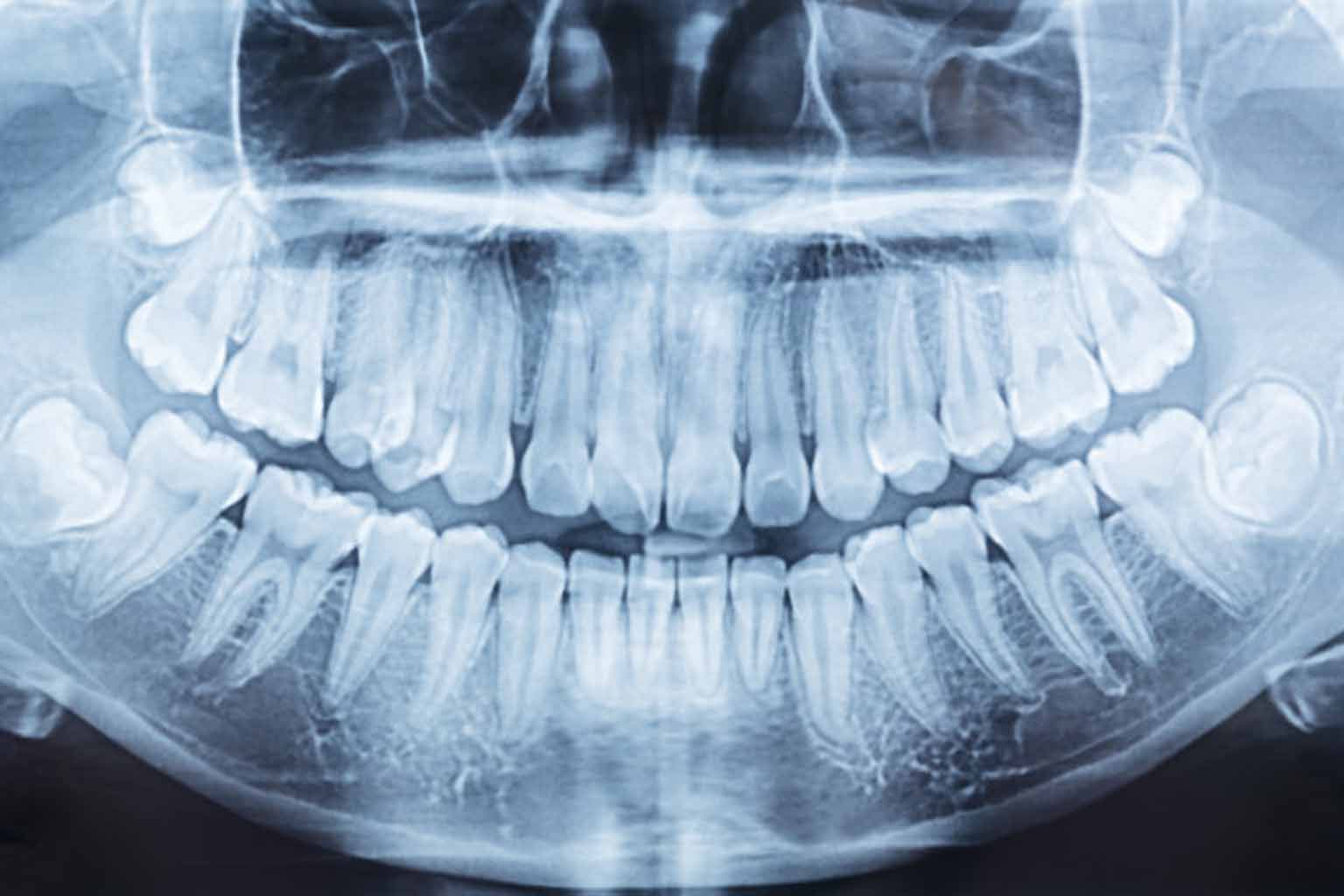Guide to Wisdom Teeth Complications
