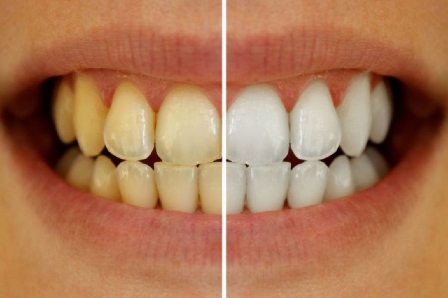 5 ways to whiten your teeth