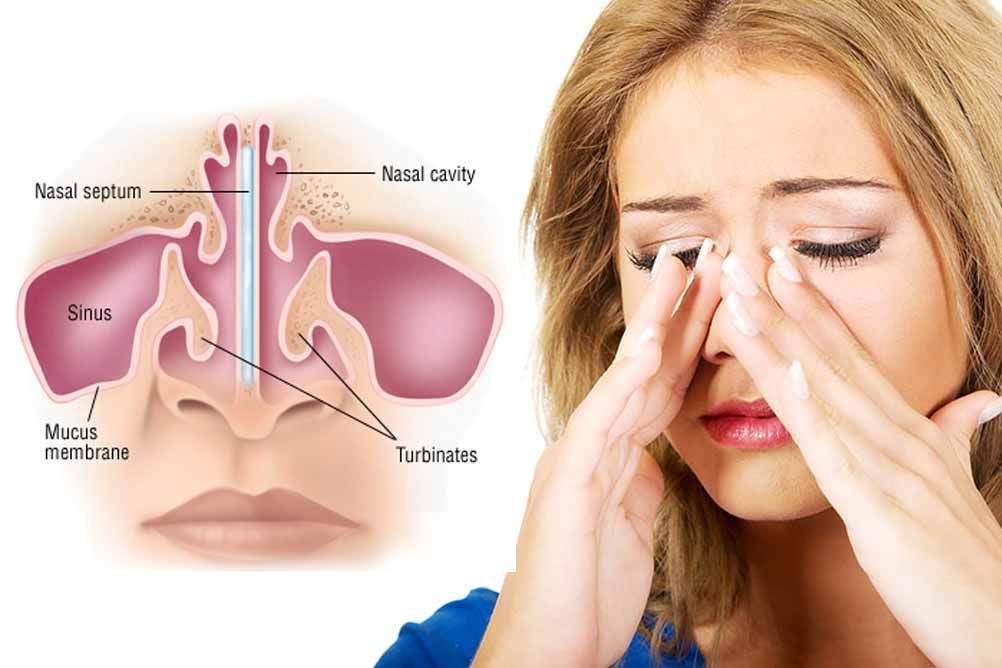 Treatment for Sinus without Surgery