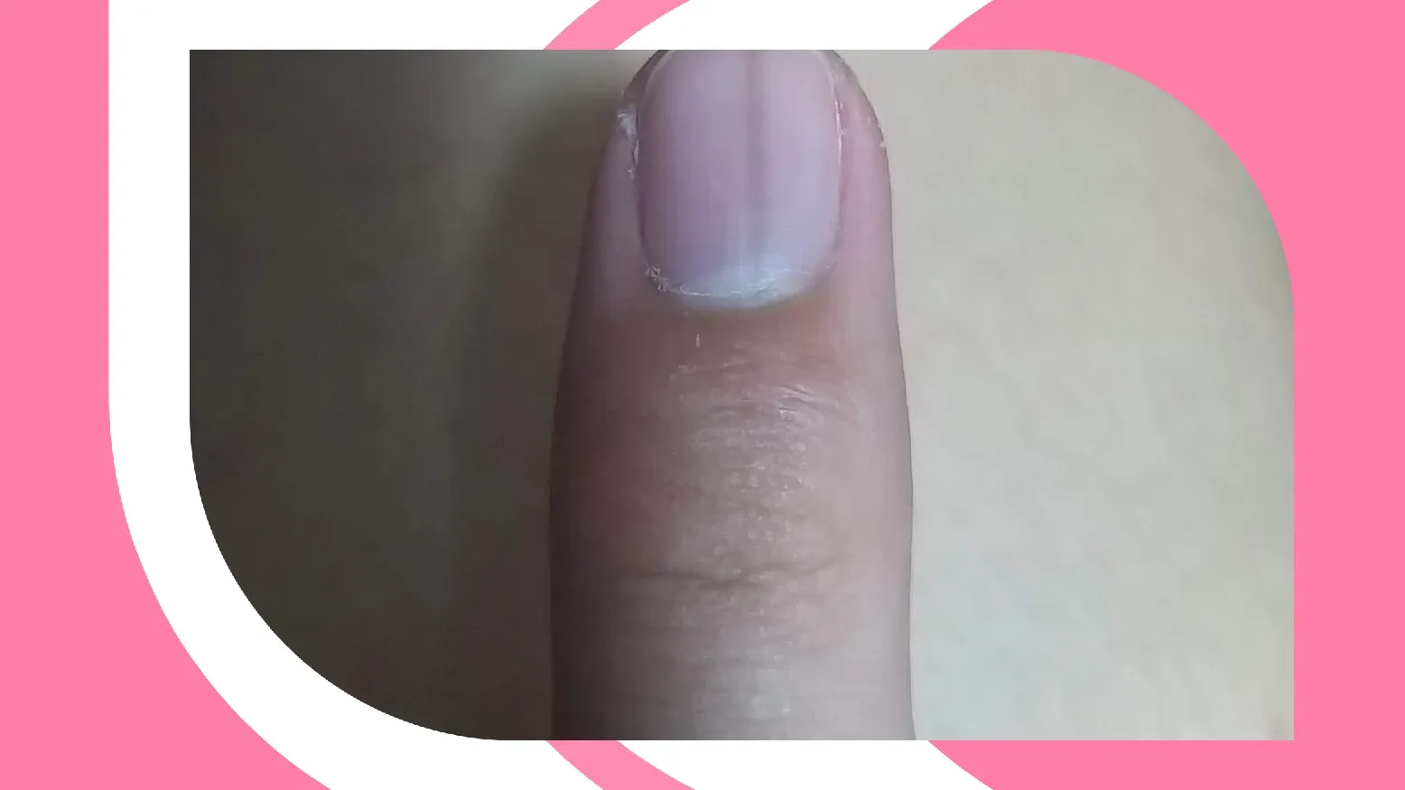 Black Line On Nail Causes Treatment