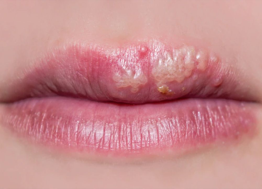 Cold sores during pregnancy