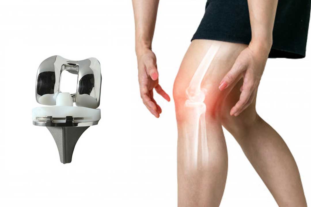 Tips to Maintain Healthy Weight and Increase Life of New Knee
