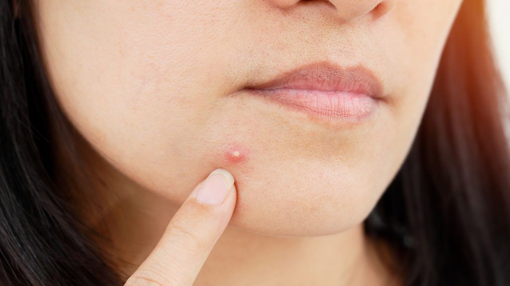 Is Azelaic Acid safe for acne?