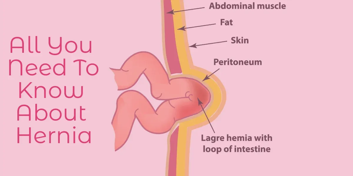 Hernia In Women