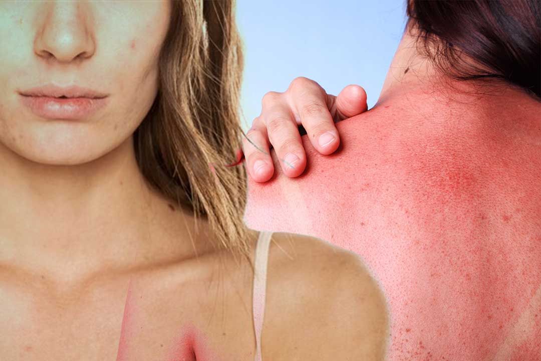 Ways to Treat Peeling off Skin