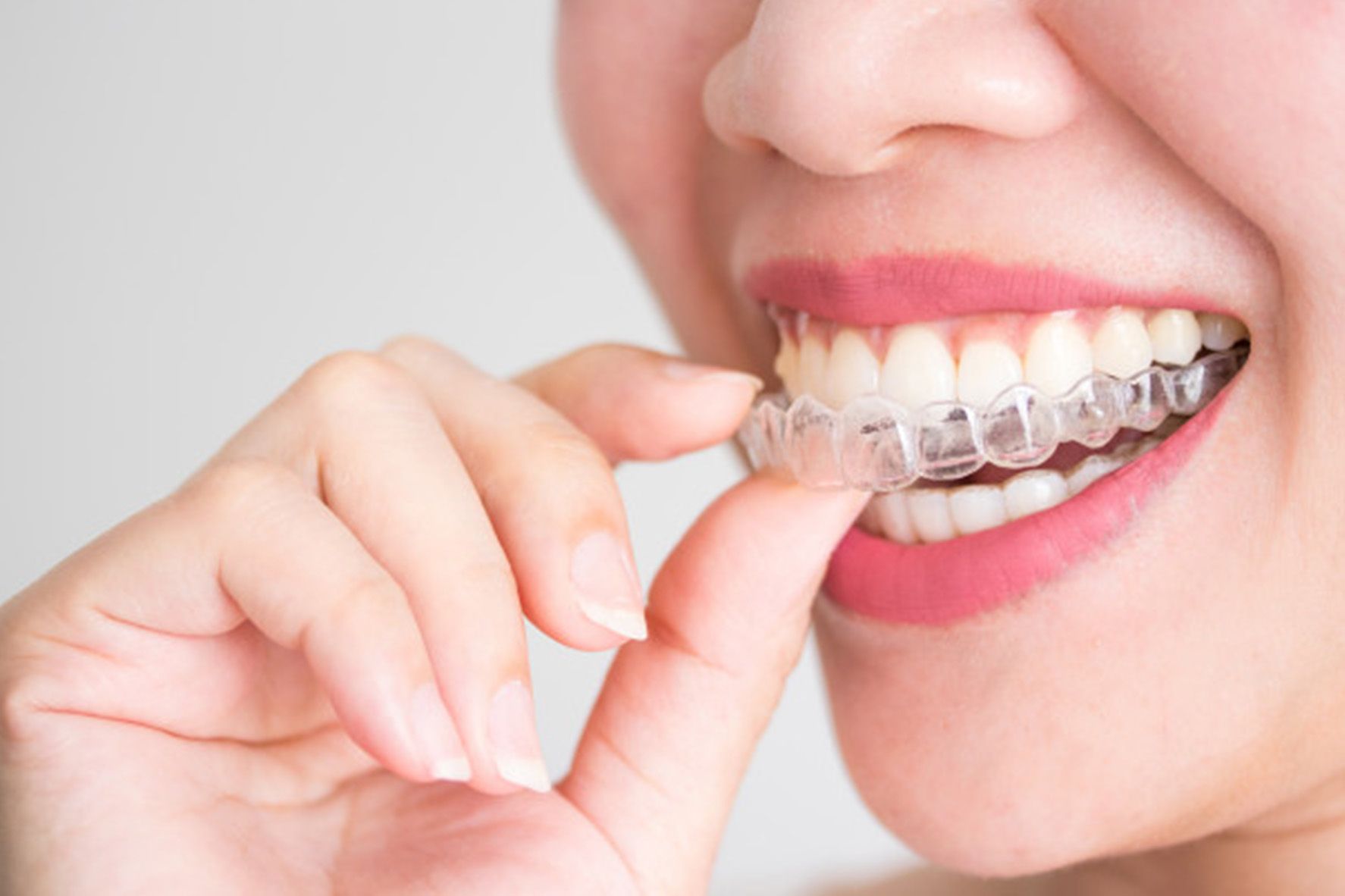 Benefits of Removable Braces