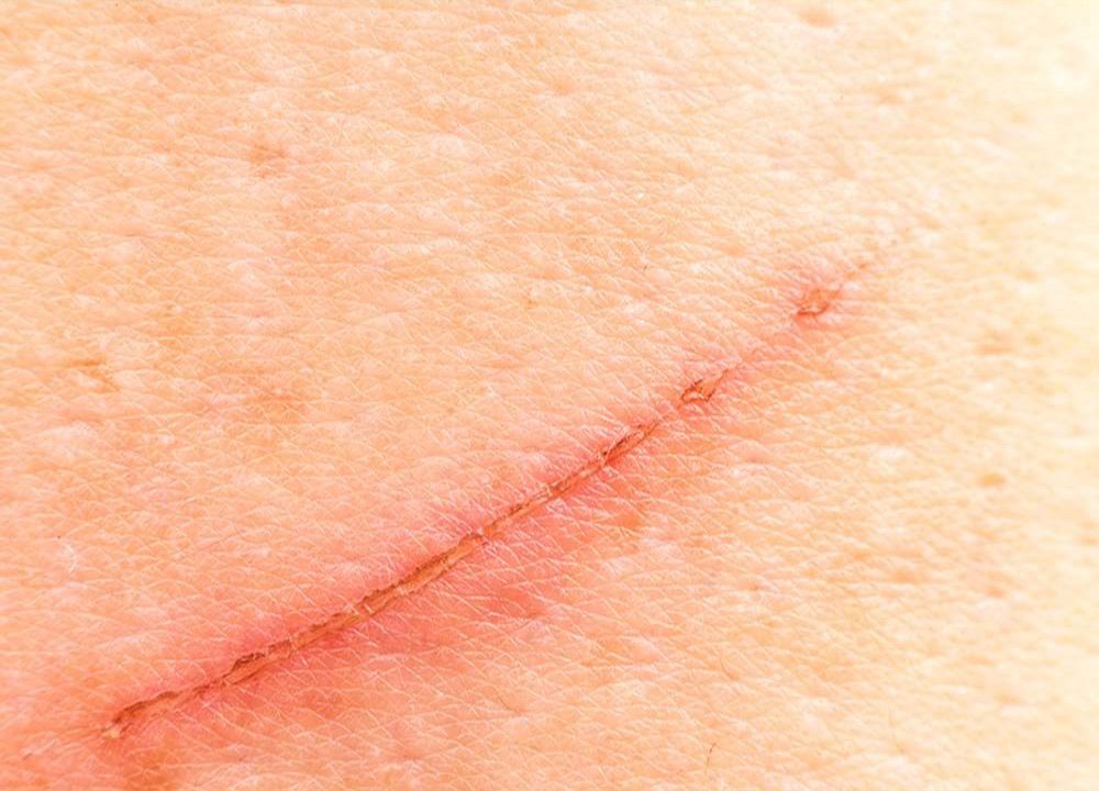 Preventing Scars From Cuts