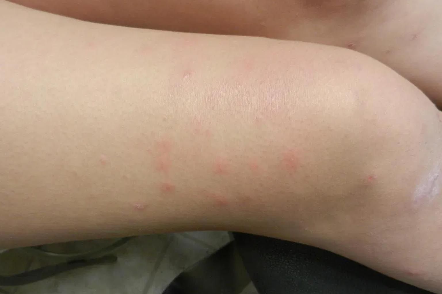 Pimples on Legs