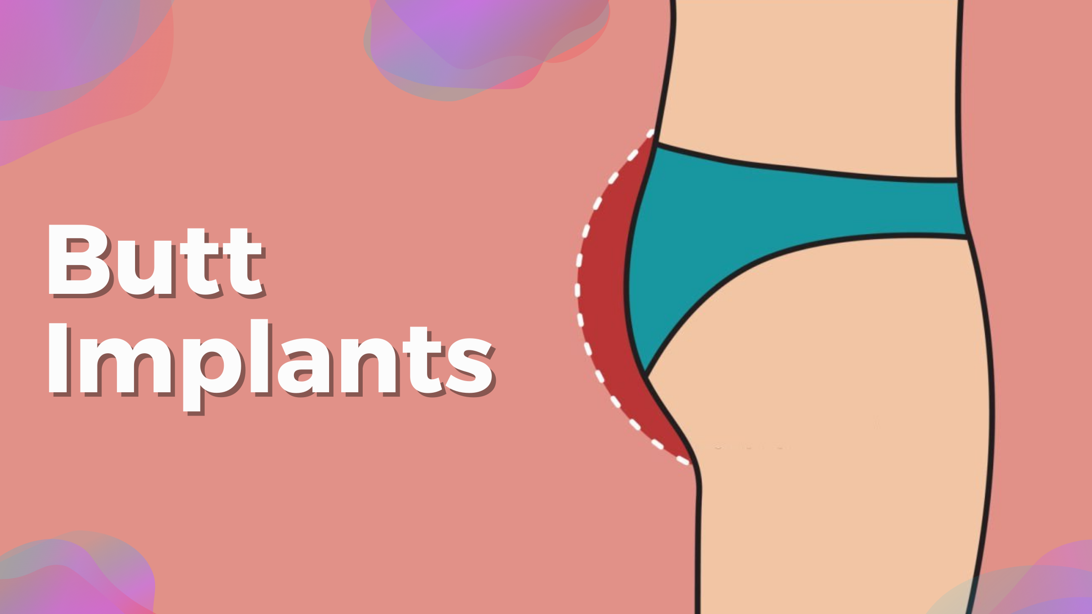 everything about butt implants